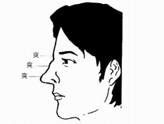 鼻梁出现三突部位，便属于“三曲鼻”了